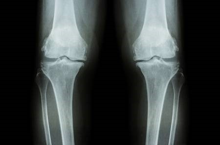 osteoarthritis-gloucestershire-1